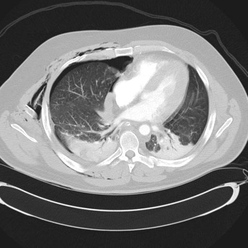 Bilateral traumatic renovascular injury (Radiopaedia 32051-32995 Axial lung window 31).jpg