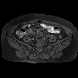 Bilateral tubo-ovarian abscesses (Radiopaedia 58635-65829 Axial T1 fat sat 3).jpg