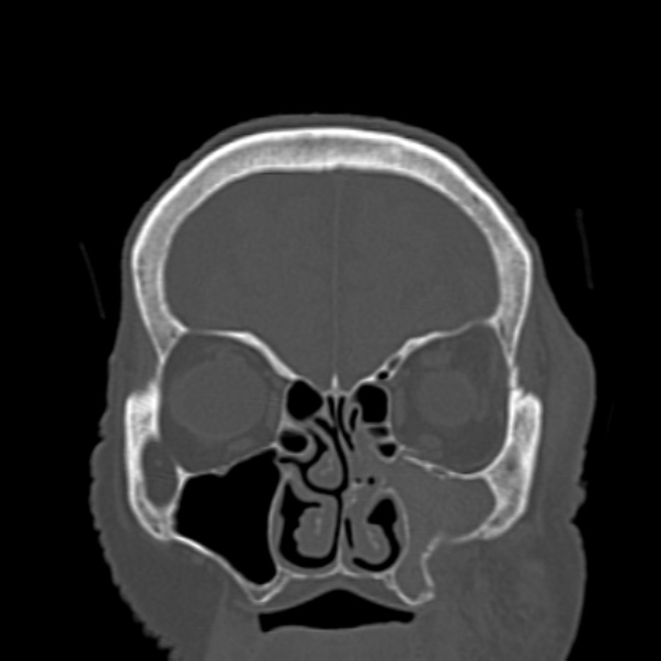 Biparietal osteodystrophy (Radiopaedia 46109-50463 Coronal bone window 27).jpg