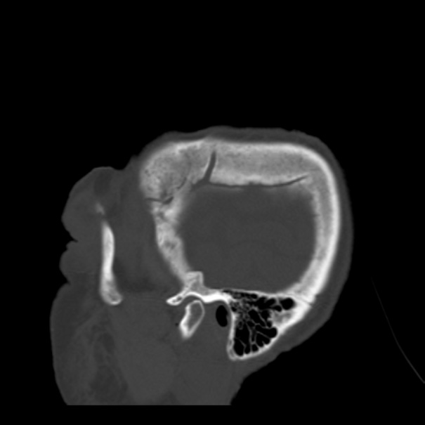 Biparietal osteodystrophy (Radiopaedia 46109-50463 Sagittal bone window 93).jpg