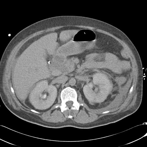 Bladder rupture post renal biopsy (Radiopaedia 30863-31572 Axial non-contrast 34).jpg
