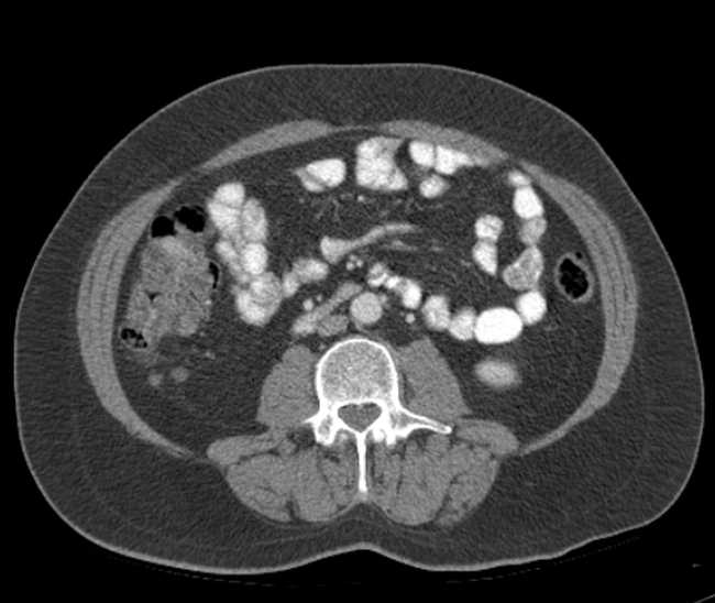 Bleeding duodenal ulcer and adenomyomatosis of gallbladder (Radiopaedia 61834-69861 A 70).jpg