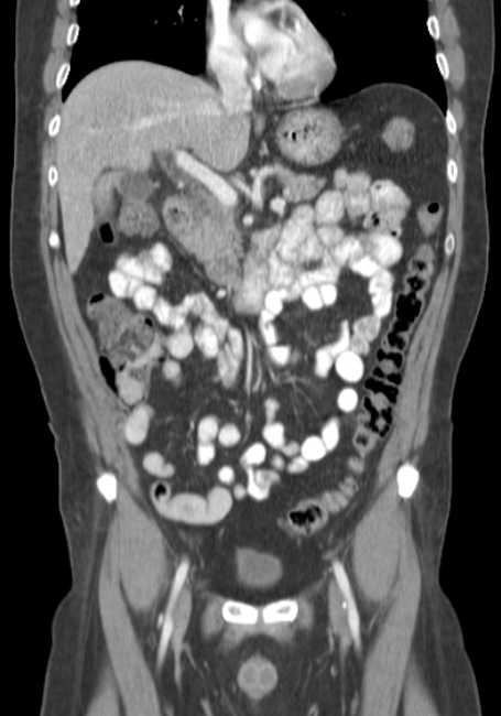 Bleeding duodenal ulcer and adenomyomatosis of gallbladder (Radiopaedia 61834-69861 B 51).jpg