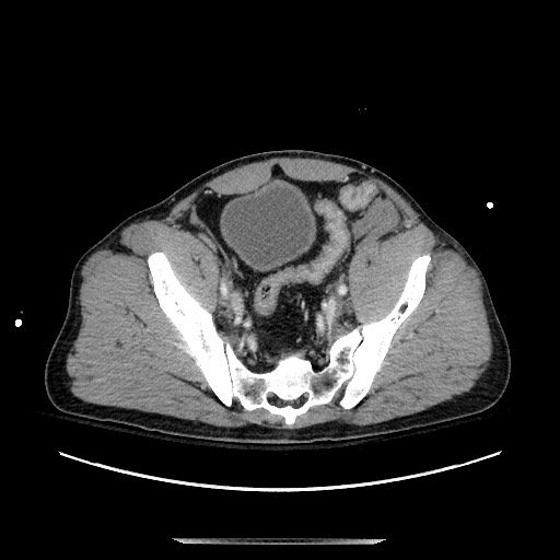 Blunt abdominal trauma with solid organ and musculoskelatal injury with active extravasation (Radiopaedia 68364-77895 A 127).jpg