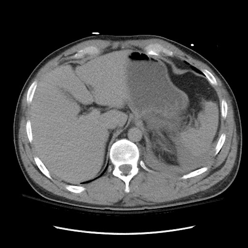 Blunt abdominal trauma with solid organ and musculoskelatal injury with active extravasation (Radiopaedia 68364-77895 Axial C+ delayed 30).jpg