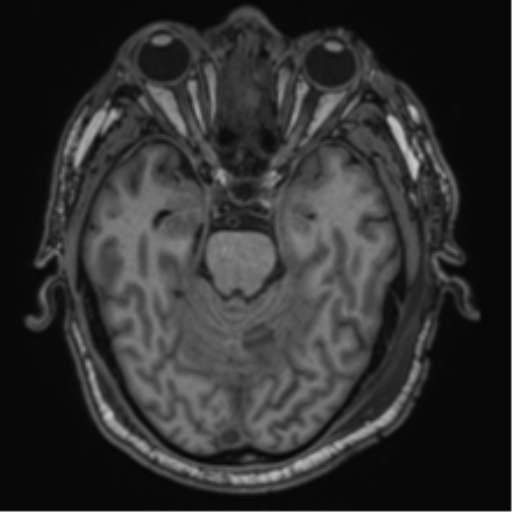 File:Blunt cerebrovascular injury (Radiopaedia 53682-59745 Axial T1 12).png