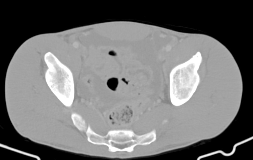 Blunt injury to the small bowel (Radiopaedia 74953-85987 Axial Wide 84).jpg