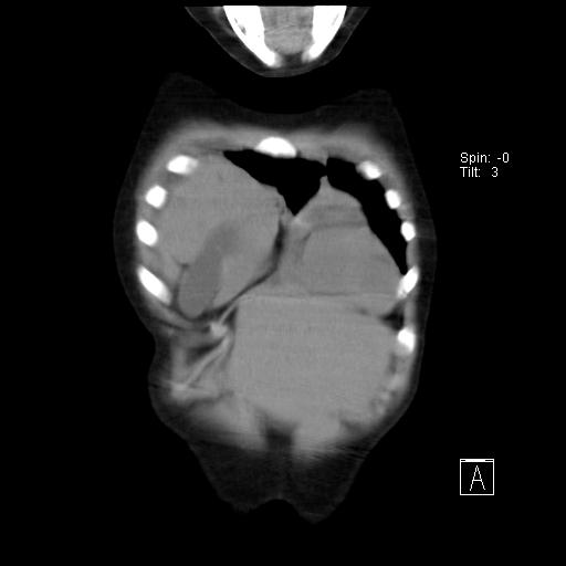File:Bochdalek diaphragmatic hernia (Radiopaedia 38866-41059 Coronal liver window 3).jpg