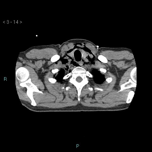 Boerhaave syndrome (Radiopaedia 27683-27897 oral contrast 14).jpg
