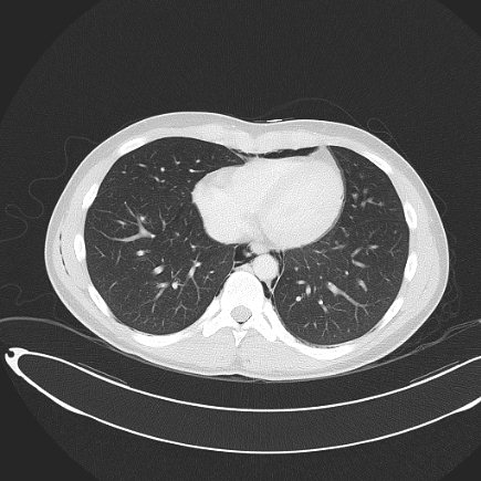 File:Boerhaave syndrome with mediastinal, axillary, neck and epidural free gas (Radiopaedia 41297-44115 Axial lung window 64).jpg