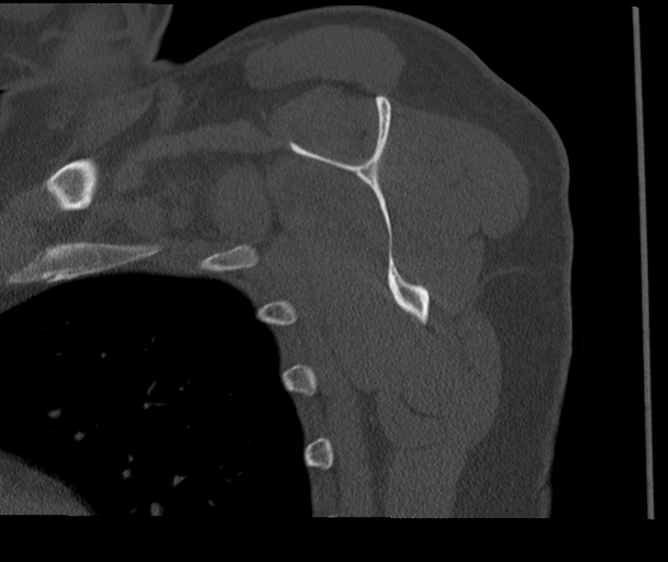 Bony Bankart and Hill-Sachs lesions (Radiopaedia 33622-34727 Sagittal bone window 46).png