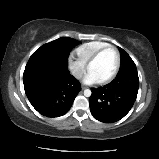 File:Borderline mucinous tumor (ovary) (Radiopaedia 78228-90808 A 31).jpg