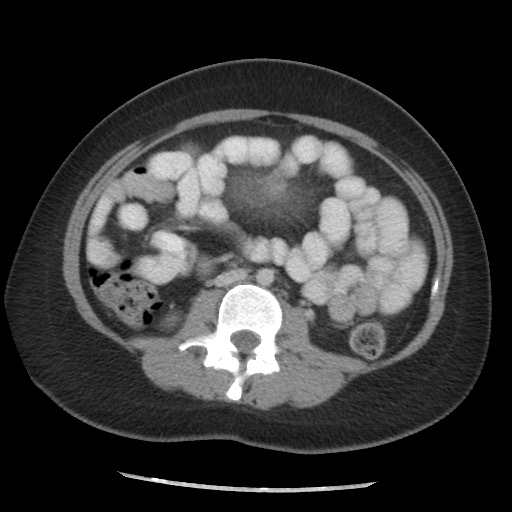 File:Borderline mucinous tumor (ovary) (Radiopaedia 78228-90808 A 92).jpg