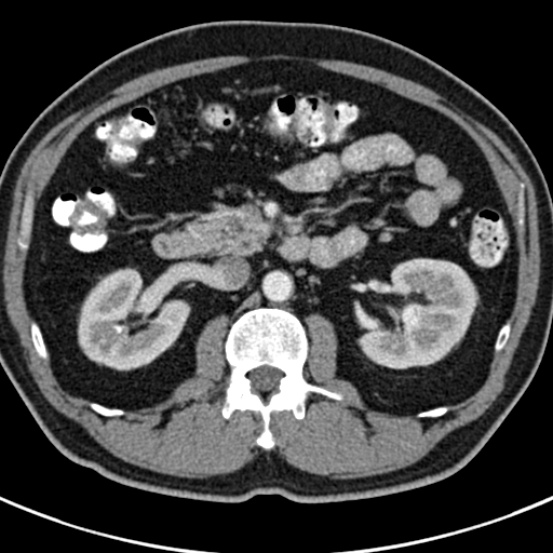 File:Bosniak cyst - type IV (Radiopaedia 23525-23627 renal cortical phase 24).jpg