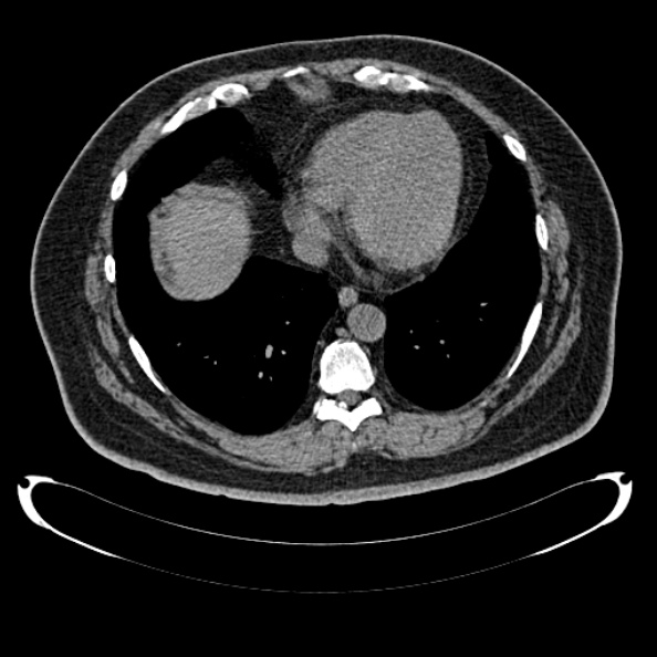 Bosniak renal cyst - type IV (Radiopaedia 24244-24518 Axial non-contrast 10).jpg