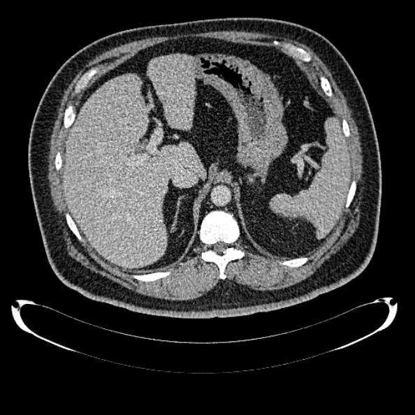 Bosniak renal cyst - type IV (Radiopaedia 24244-24518 C 68).jpg