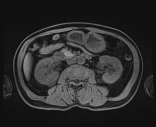 Bouveret syndrome (Radiopaedia 61017-68856 Axial T1 fat sat 46).jpg