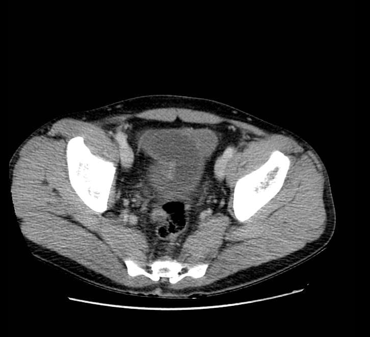 Bowel obstruction from colon carcinoma (Radiopaedia 22995-23028 A 75).jpg