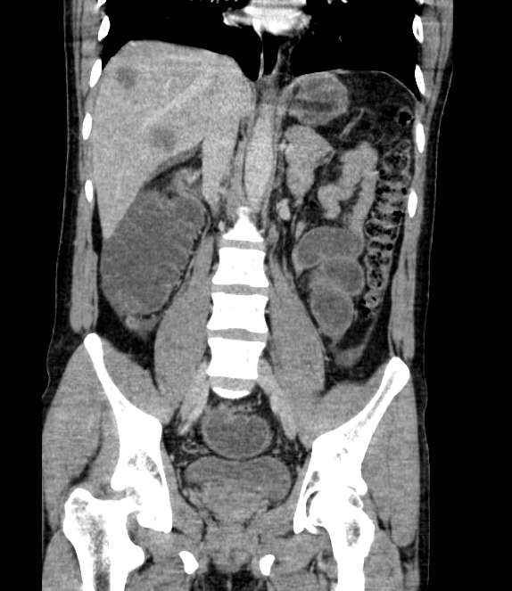 Bowel obstruction from colon carcinoma (Radiopaedia 22995-23028 C 43).jpg