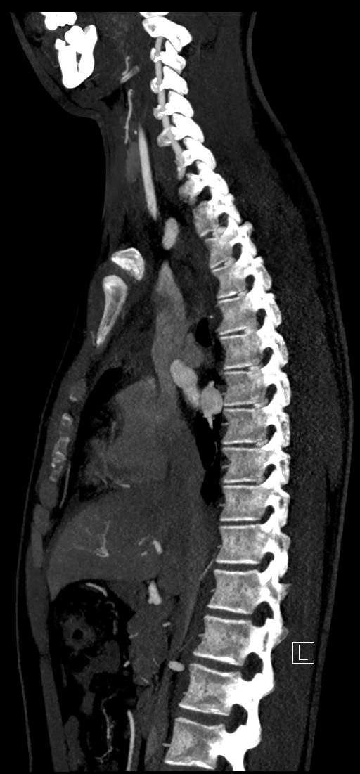 Brachiocephalic trunk pseudoaneurysm (Radiopaedia 70978-81191 C 43).jpg