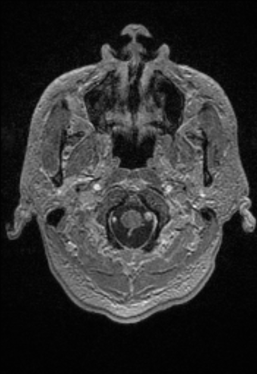 Brain abscess with ventriculitis (Radiopaedia 85703-101495 Axial T1 C+ 18).jpg