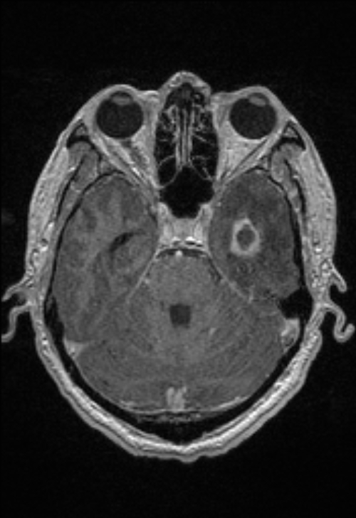 Brain abscess with ventriculitis (Radiopaedia 85703-101495 Axial T1 C+ 60).jpg