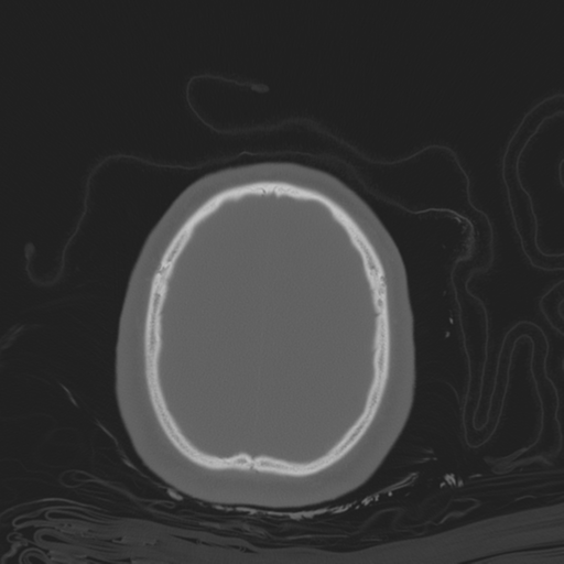 File:Brain contusions, internal carotid artery dissection and base of skull fracture (Radiopaedia 34089-35339 Axial bone window 101).png