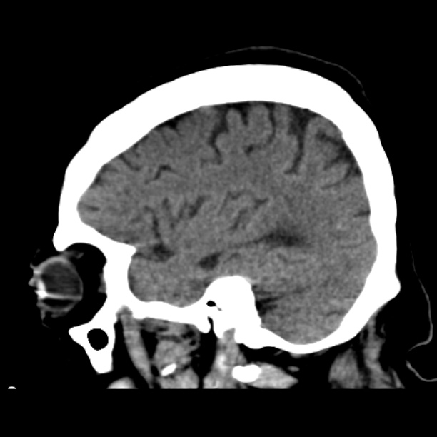Brain cortical laminar necrosis (Radiopaedia 25822-25971 non-contrast 15).jpg