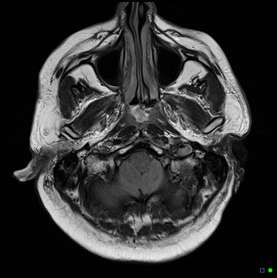 File:Brain death on MRI and CT angiography (Radiopaedia 42560-45689 Axial FLAIR 3).jpg