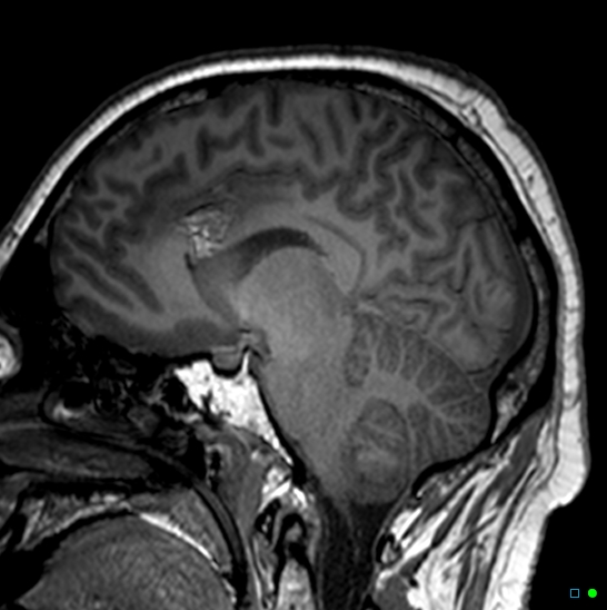 Brain death on MRI and CT angiography (Radiopaedia 42560-45689 Sagittal T1 18).jpg