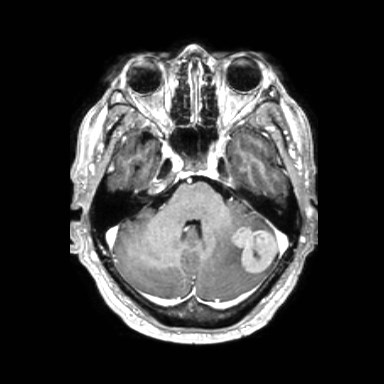 File:Brain metastases from lung cancer (Radiopaedia 83839-99028 Axial T1 C+ 14).jpg