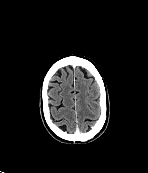 Brain metastasis (large cystic mass) (Radiopaedia 47497-52106 Axial C+ 49).png