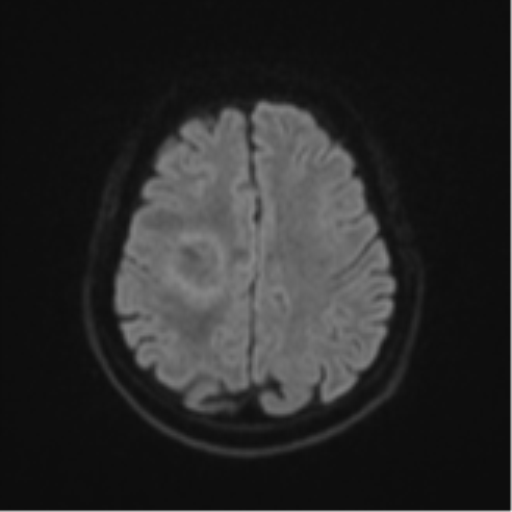 Brain metastasis (sarcoma) (Radiopaedia 47576-52209 Axial DWI 47).png