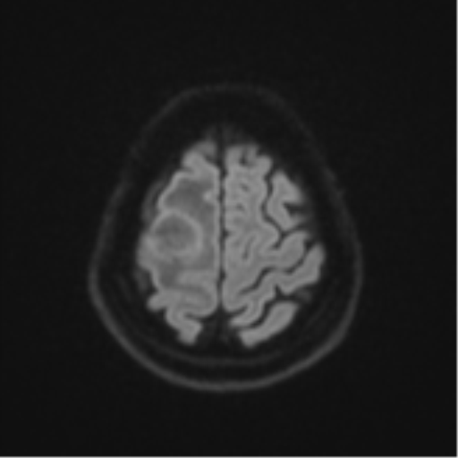 Brain metastasis (sarcoma) (Radiopaedia 47576-52209 Axial DWI 51).png