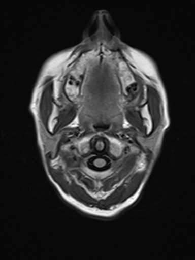 File:Brain metastasis as initial presentation of non-small cell lung cancer (Radiopaedia 65122-74126 Axial FLAIR 1).jpg