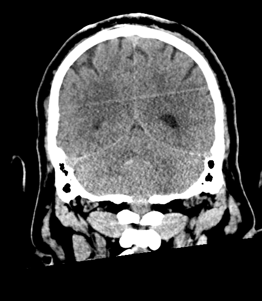 Brainstem hemorrhage (Radiopaedia 81294-94976 Coronal non-contrast 50).jpg