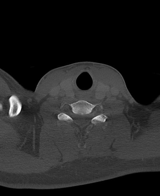Branchial cleft cyst (Radiopaedia 31167-31875 Axial bone window 55).jpg