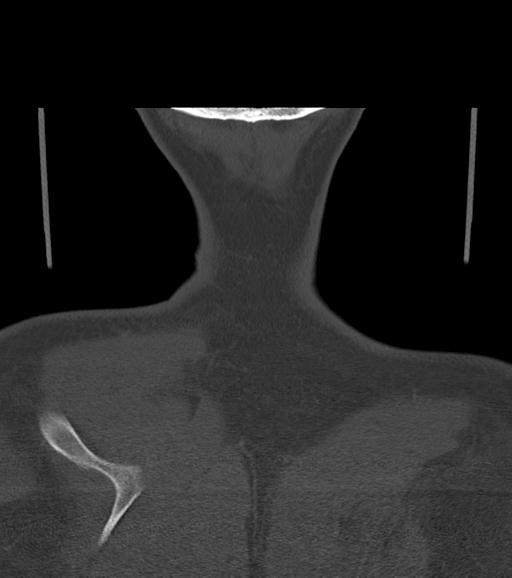 Branchial cleft cyst (Radiopaedia 31167-31875 Coronal bone window 63).jpg