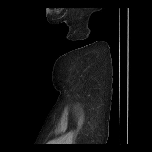 Breast cancer pseudocirrhosis (Radiopaedia 65406-74454 C 32).jpg