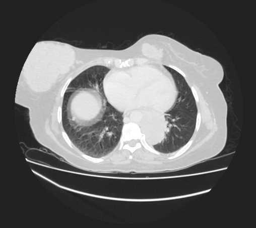Breast metastases from facial malignant melanoma (Radiopaedia 60316-67975 Axial lung window 74).jpg
