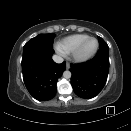 Breast metastases from renal cell cancer (Radiopaedia 79220-92225 C 3).jpg