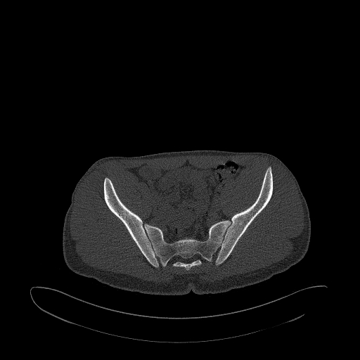 Brodie abscess- femoral neck (Radiopaedia 53862-59966 Axial bone window 69).jpg