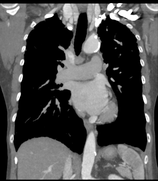 Bronchial artery aneurysms (Radiopaedia 42282-45385 Coronal C+ delayed 34).png