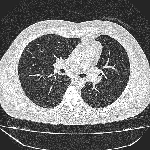 File:Bronchial atresia (Radiopaedia 58271-65417 Axial lung window 22).jpg
