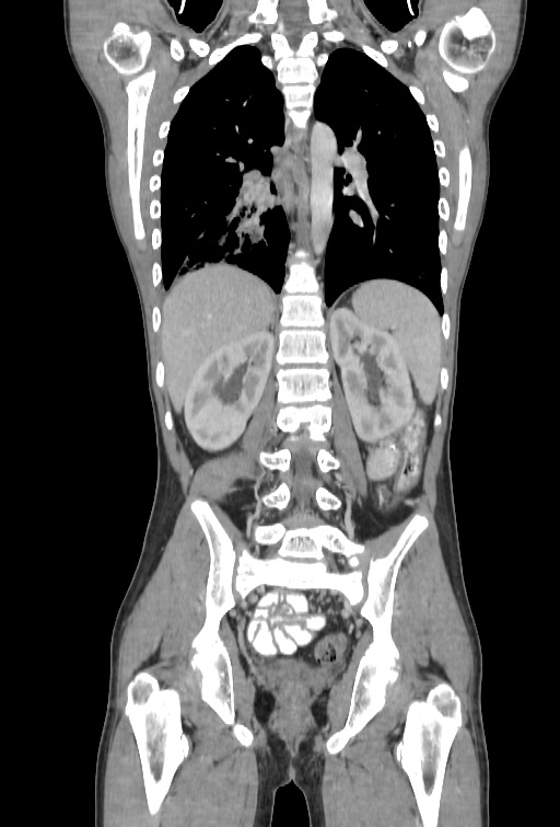 Bronchial carcinoid tumor (Radiopaedia 57187-64090 B 79).jpg