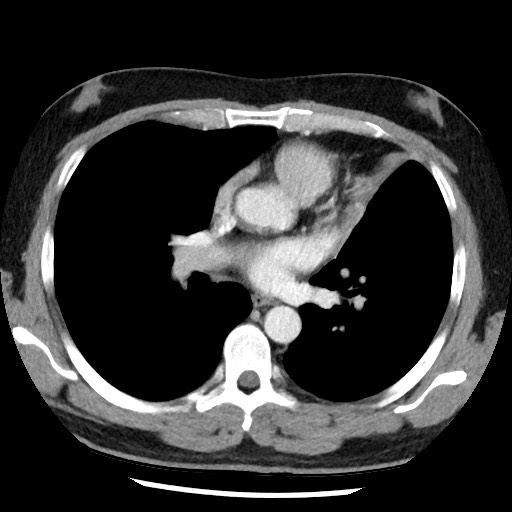Bronchial carcinoid tumor (Radiopaedia 67377-76764 A 33).jpg