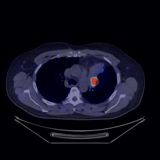 Bronchial carcinoid tumor (Radiopaedia 67377-76765 68Ga-DOTATATE PET-CT 27).jpg