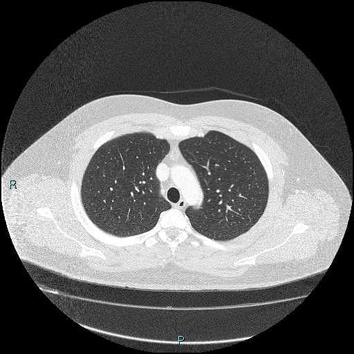 Bronchial carcinoid tumor (Radiopaedia 78272-90875 Axial lung window 12).jpg