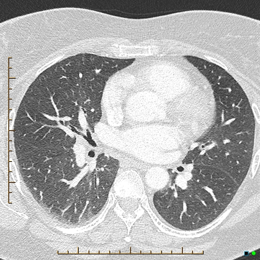 File:Bronchial diverticula (Radiopaedia 79512-92676 Axial lung window 102).jpg