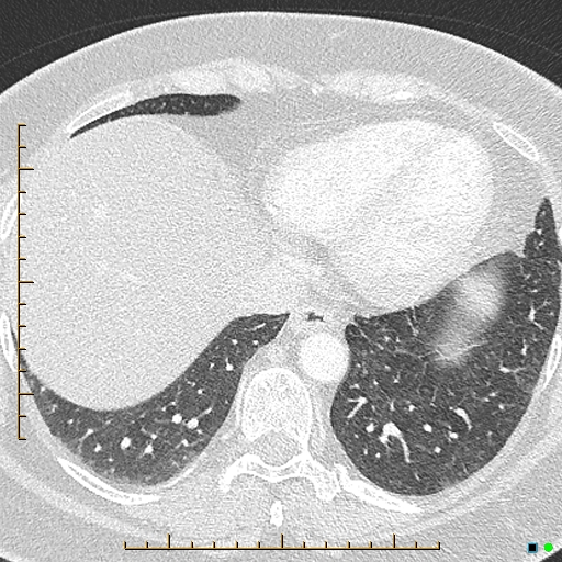 Bronchial diverticula (Radiopaedia 79512-92676 Axial lung window 163).jpg